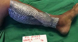 Fish Skin Bandages - Could fish scales hold the key to rapid wound recovery?