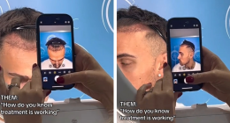 How Ben from Love Island Transformed After £3000 Hair Transplant