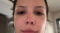 Halsey’s Brave Selfie Reveals Life with Lupus and Rare Disorder: Fans Respond with Support