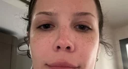 Halsey’s Brave Selfie Reveals Life with Lupus and Rare Disorder: Fans Respond with Support