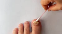 Say Goodbye to Toenail Fungus: Expert-Approved Home Solutions You Can Try Today