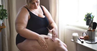 Lipedema vs. Cellulite: What Every Woman Must Know
