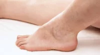Chronic Venous Insufficiency: Early Signs Women Must Know