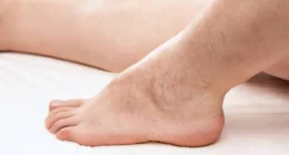 Chronic Venous Insufficiency: Early Signs Women Must Know