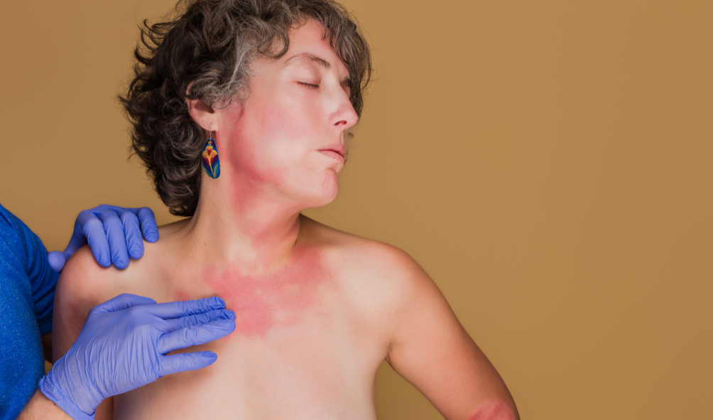 Home Remedies for Eczema, Rosacea & Dandruff: Fast Relief