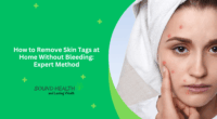 How to Remove Skin Tags at Home Without Bleeding: Expert Method