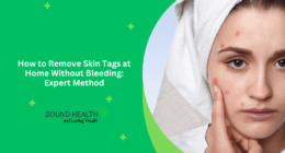 How to Remove Skin Tags at Home Without Bleeding: Expert Method