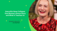 Vasculitis Nose Collapse: One Woman's Brave Story and What It Teaches Us